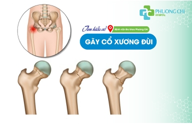 PCGH: Tìm hiểu về gãy cổ xương đùi
