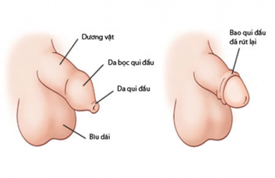 Hẹp bao quy đầu - Bệnh viện Đa khoa Phương Chi