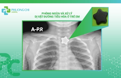 Phòng ngừa và xử lý dị vật đường tiêu hóa ở trẻ em: Câu chuyện từ Bệnh viện Đa khoa Phương Chi