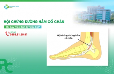 Hội Chứng Đường Hầm Cổ Chân: Khi Dây Thần Kinh Bị Mắc Kẹt