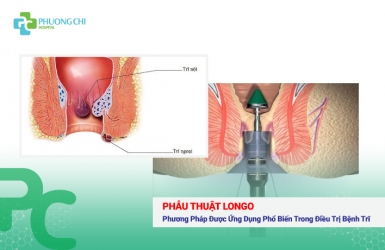 Phẫu Thuật Longo: Phương Pháp Được Ứng Dụng Phổ Biến Trong Điều Trị Bệnh Trĩ