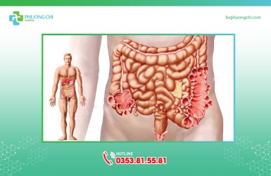 Viêm túi thừa đại tràng: Triệu chứng và cách điều trị